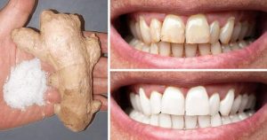 DIY Natural Teeth Whitening Remedies At Home [2024]