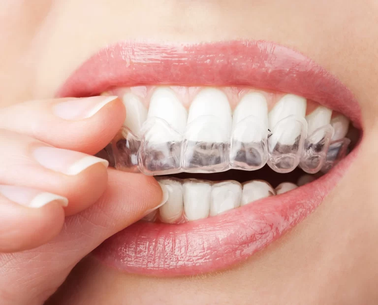 Affordable Teeth Whitening Products That Actually Work 2024